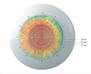 Cassini - Topografía - Innova Ocular ICO Barcelona