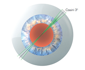Cassini - Topografía - Innova Ocular ICO Barcelona