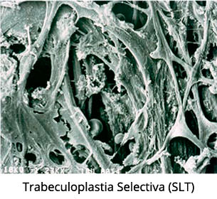 Trabeculoplastia Selectiva (SLT) - IO·ICO Barcelona