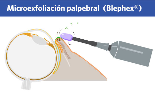 Blephex - Blefaritis anterior - IO·ICO Barcelona
