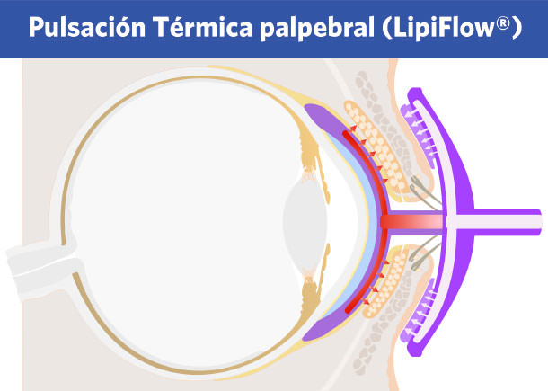 Lipiflow - Blefaritis posterior - IO·ICO Barcelona
