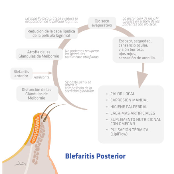 Blefaritis posterior - IO·ICO Barcelona