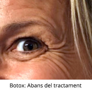 Botox Abans del tractament - IO·ICO Barcelona