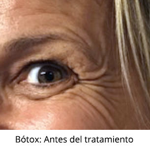 Antes - Bótox - Ojos - IO·ICO Barcelona