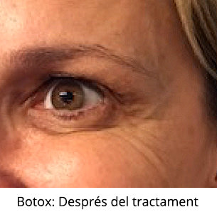 Botox - Després del tractament - IO·ICO Barcelona