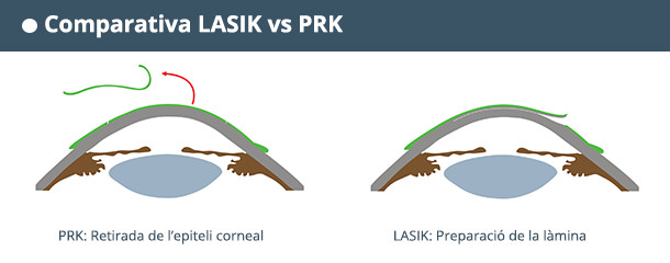 Comparativa LASIK vs PRK