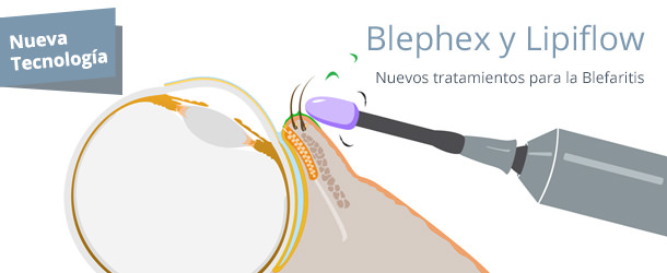 Blefaritis: Blephex y Lipiflow - IO·ICO Barcelona
